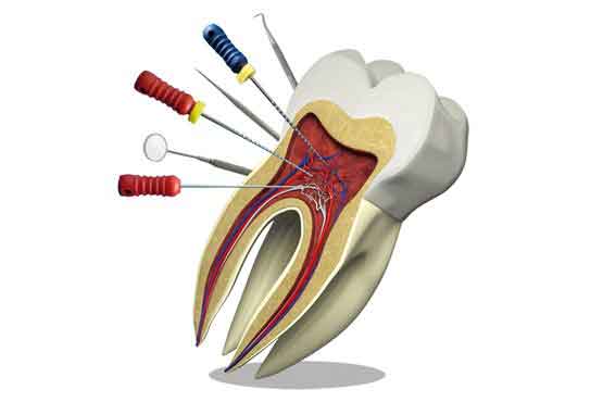 درمان ريشه دندان (Root Canal Therapy) چيست؟