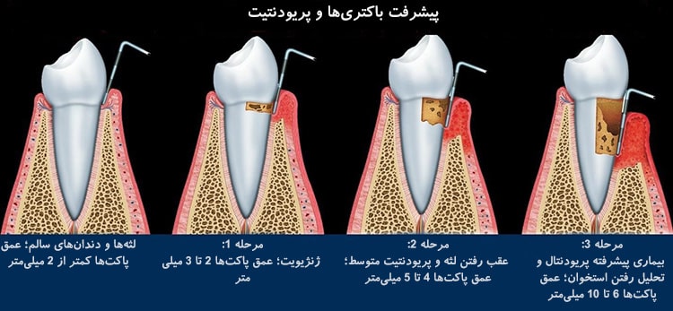 بیماری-پریودنتال-min.jpg بیماری-پریودنتال-min.jpg
