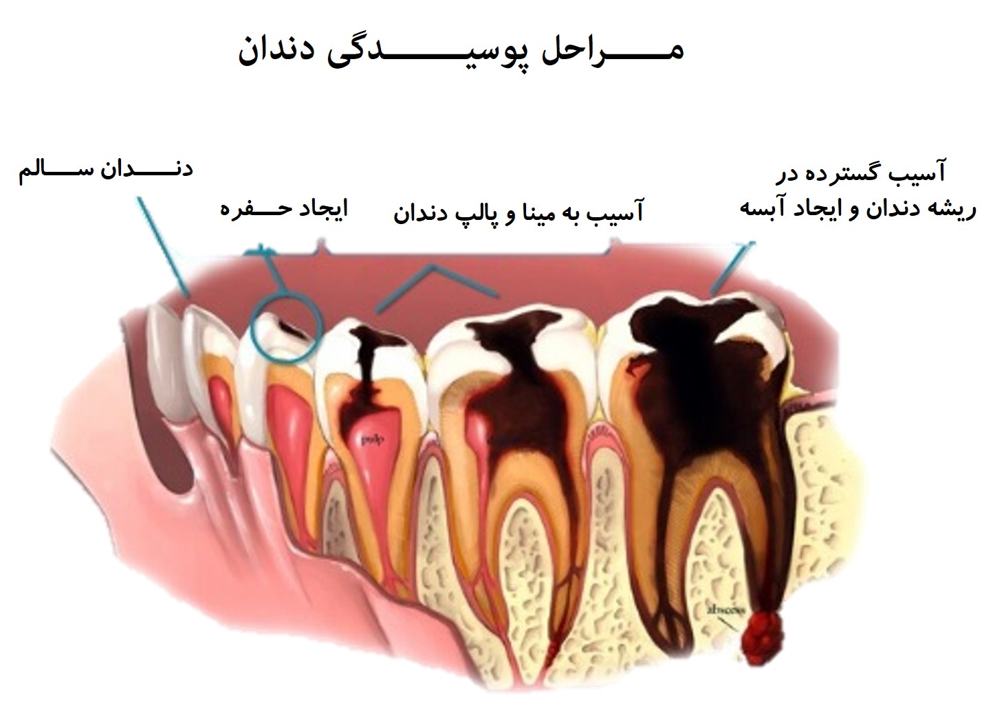 جلوگیری از پیشرفت پوسیدگی دندان.jpg