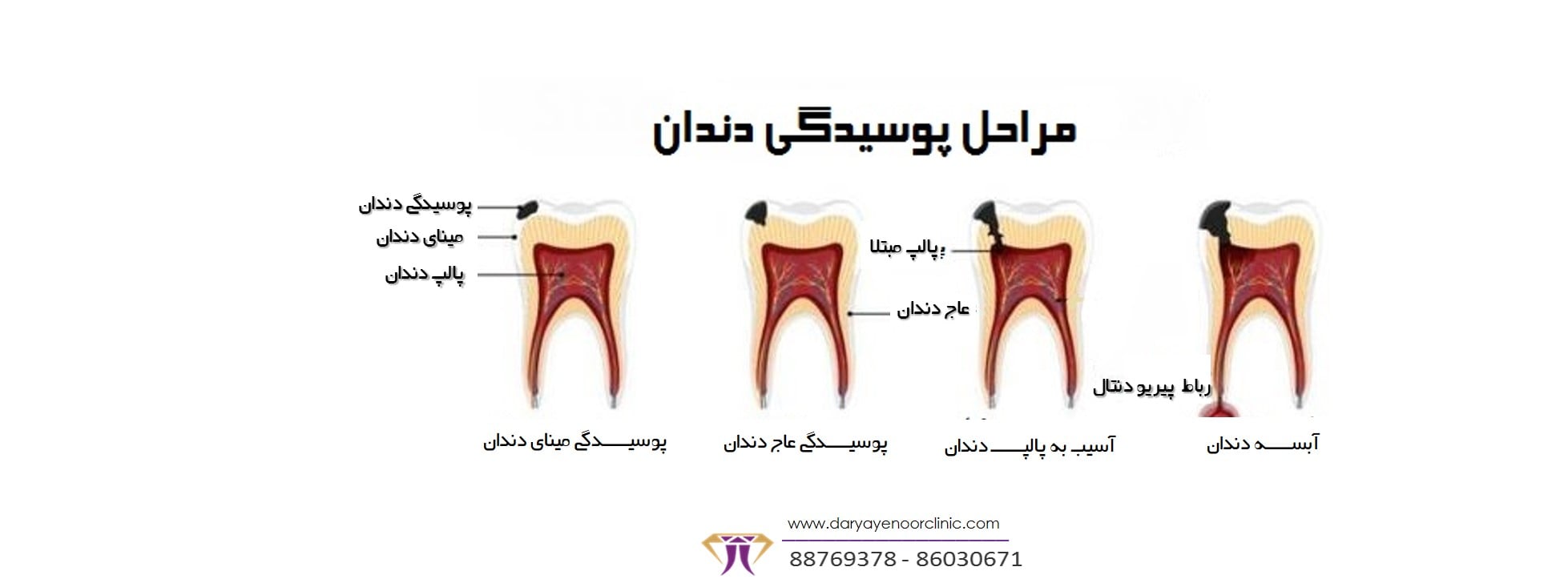 جلوگیری از پیشرفت پوسیدگی دندان_کلینیک دندانپزشکی دریای نور-min.jpg