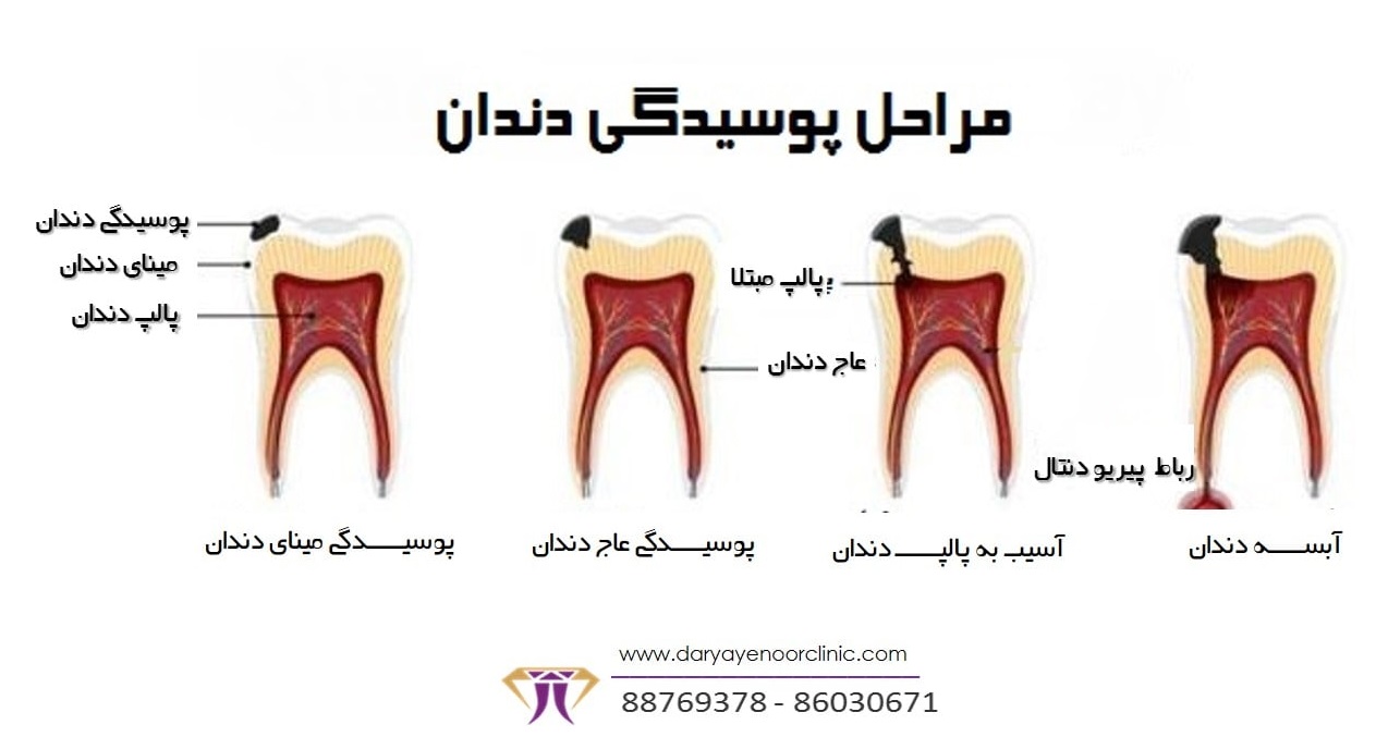 جلوگیری -از-پیشرفت-پوسیدگی-دندان_-.jpg
