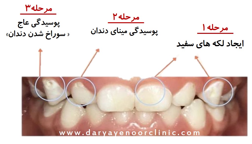 دمینرالیزاسیون چیست.jpg