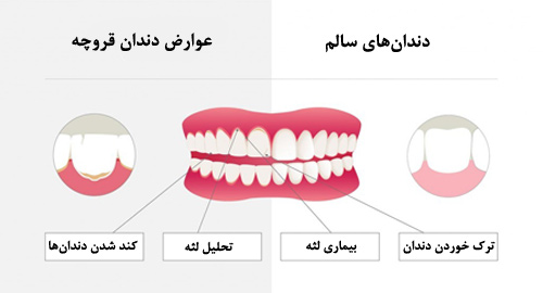 دندان-قروچه دندان-قروچه