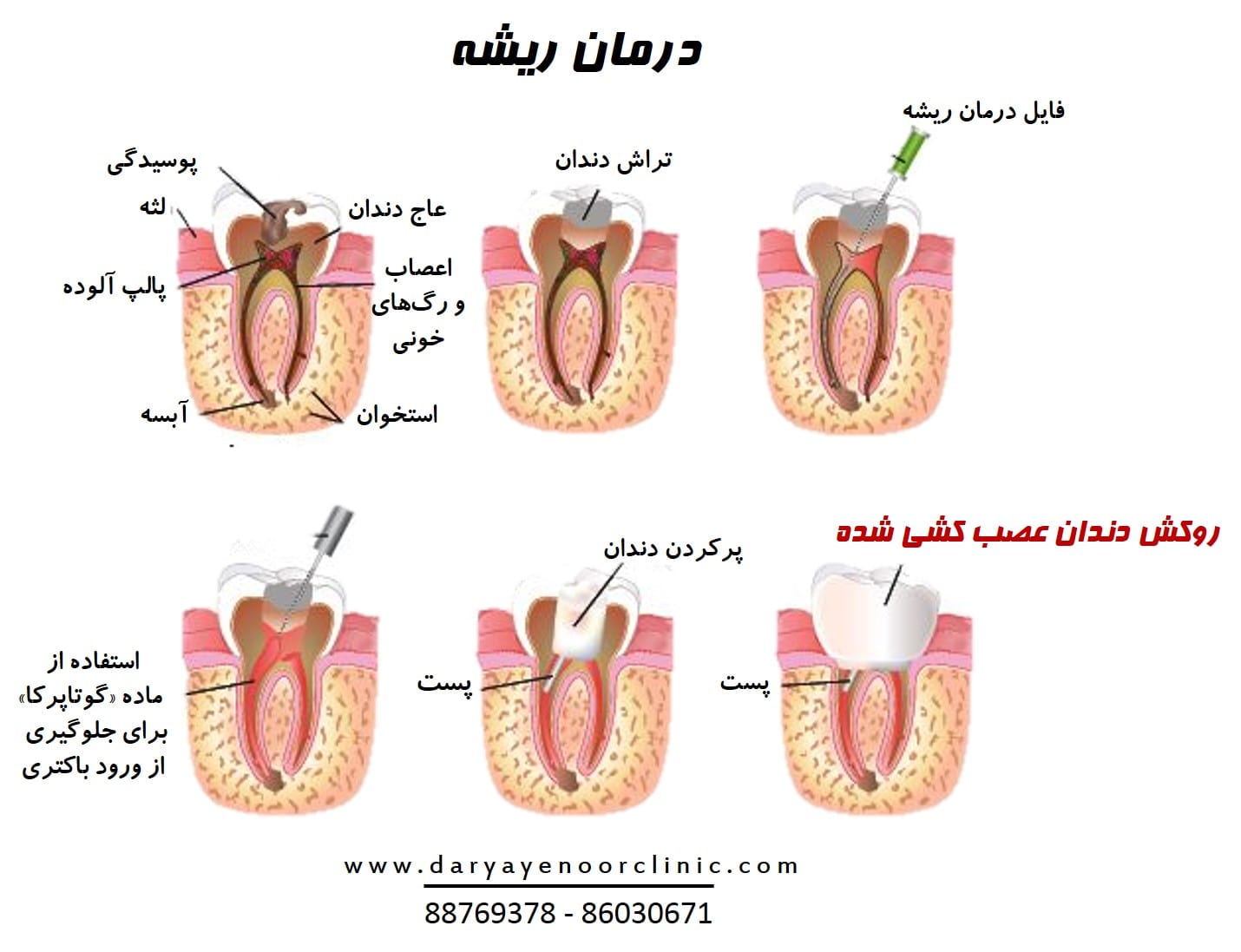 روکش دندان عصب کشی شده-min.jpg