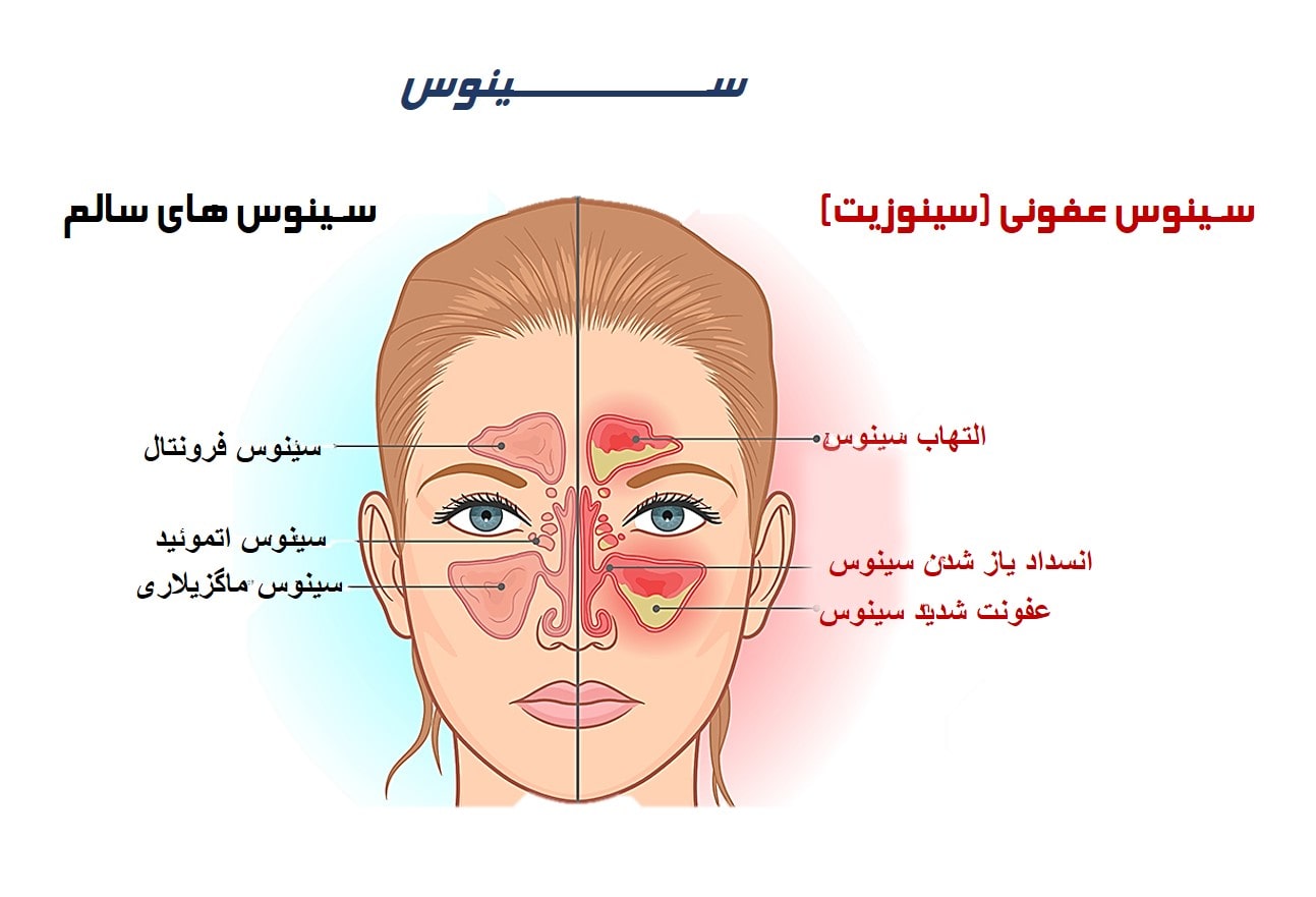 عفونت سینوسی-min.jpg
