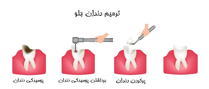 مراحل پوسیدگی دندان جلو.jpg مراحل پوسیدگی دندان جلو.jpg