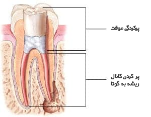 نحوه درمان ریشه دندان.png نحوه درمان ریشه دندان.png
