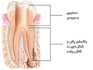نحوه درمان ریشه.png نحوه درمان ریشه.png