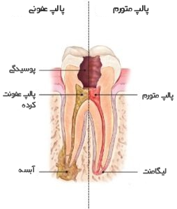 نحوه عصب کشی و پر کردن دندان.png نحوه عصب کشی و پر کردن دندان.png