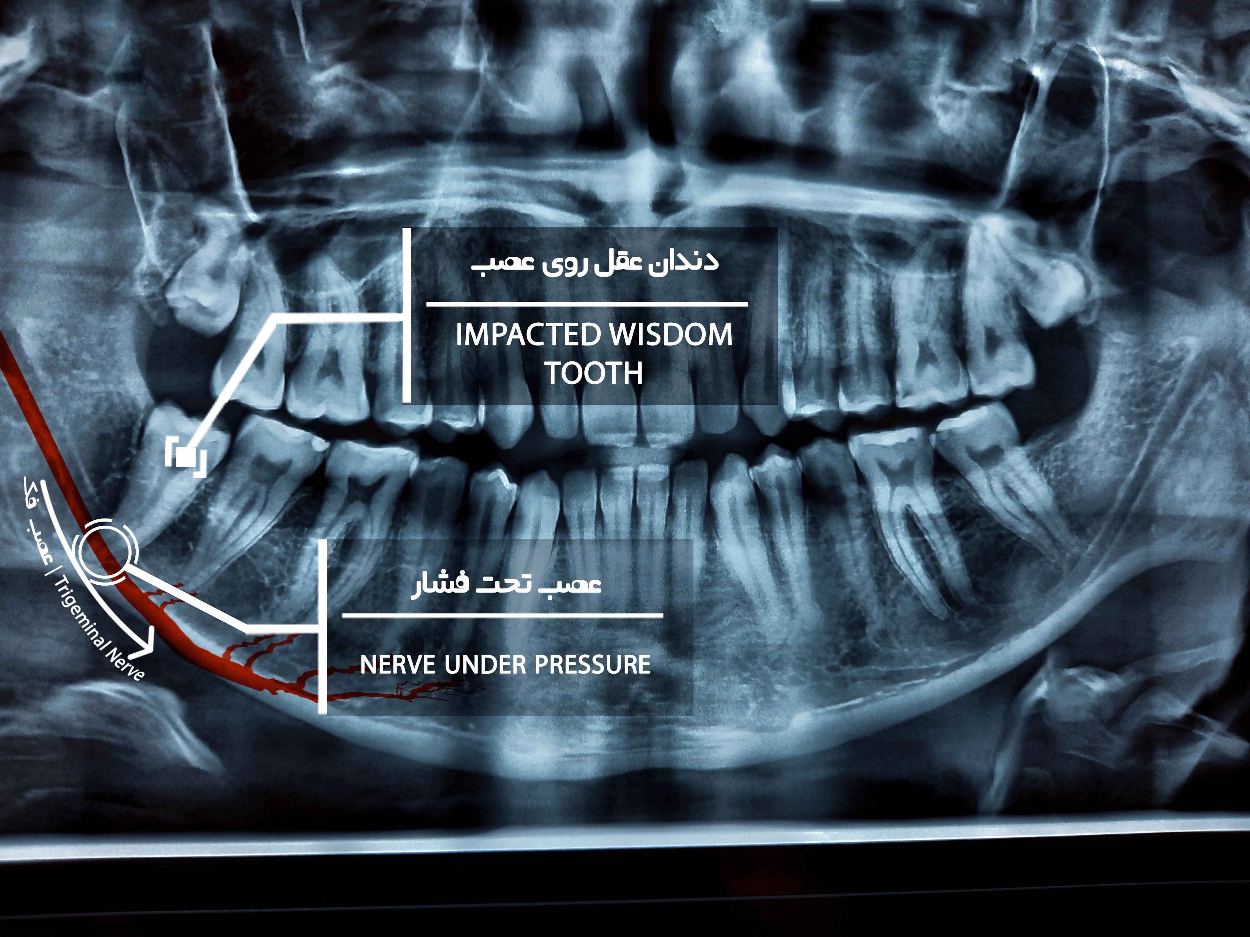 نزدیک به عصب-Recovered (1)-min.jpg
