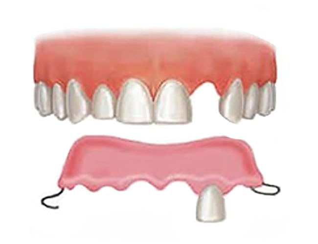 پر کردن موقت دندان جلو.jpg