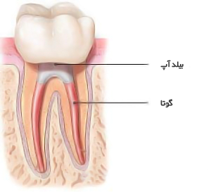 چگونگی عصب کشی.png چگونگی عصب کشی.png