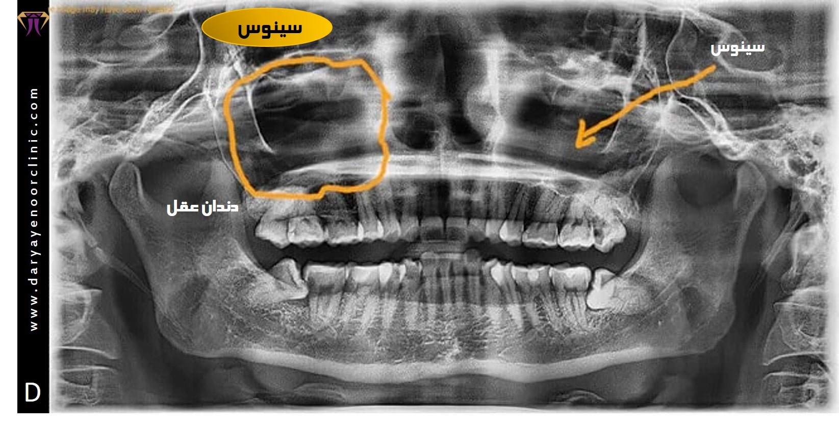 کشیدن دندان داخل سینوس-min.jpg