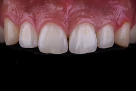 (Diastema).jpg