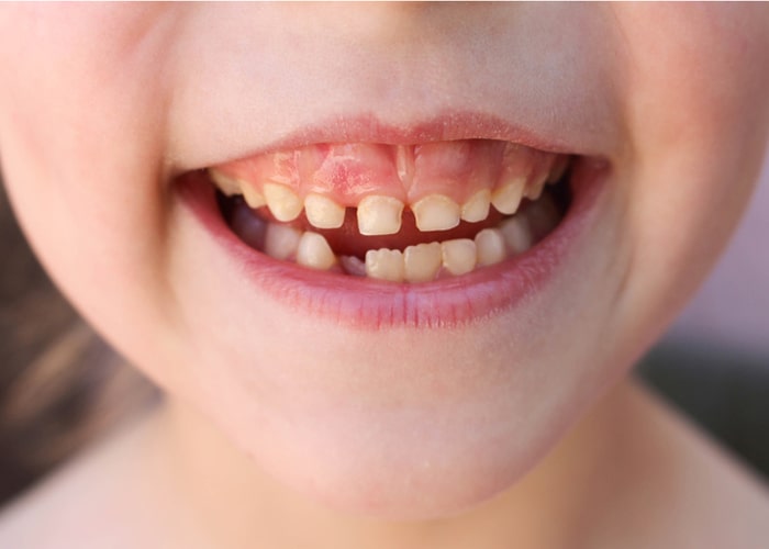 Ankylosed teeth of milk teeth-min.jpg Ankylosed teeth of milk teeth-min.jpg