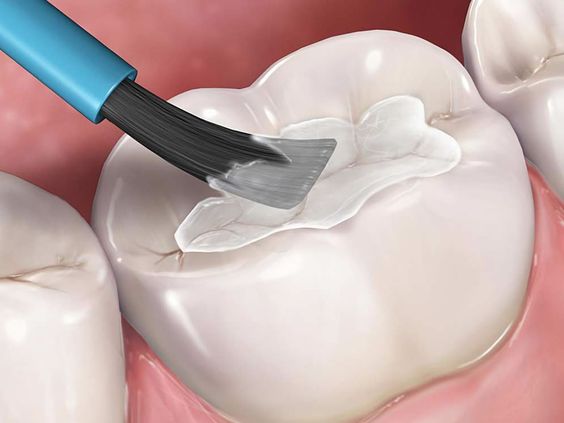Dental Caries composit.jpg