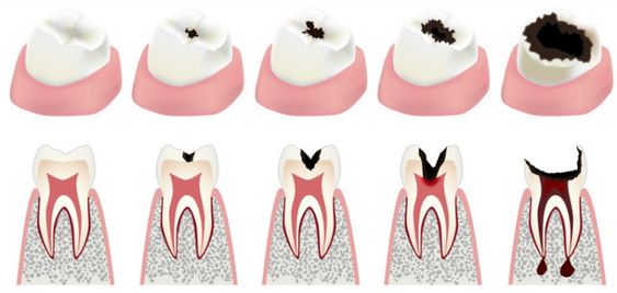 Dental caries.jpg