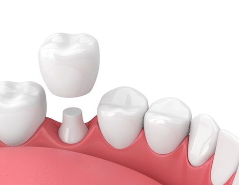 Dental crowns.jpg Dental crowns.jpg