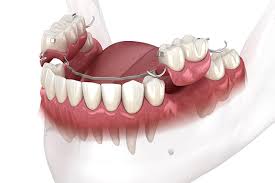 Dental flipers.jpg