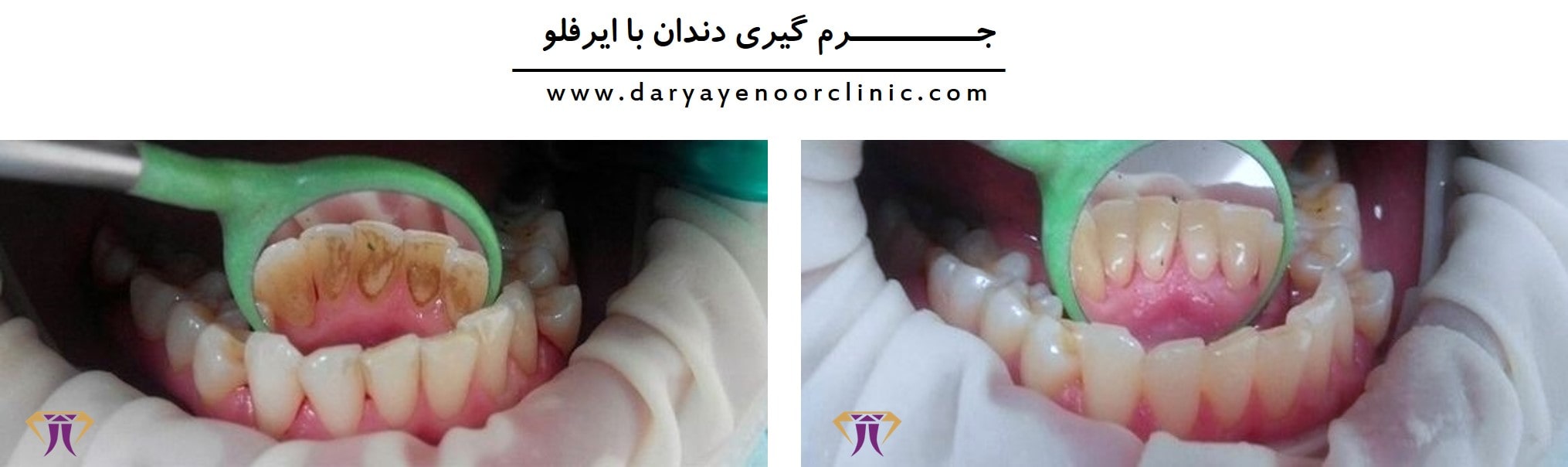 جرم-گیری-دندان-با-ایرفلو-min.jpg جرم-گیری-دندان-با-ایرفلو-min.jpg