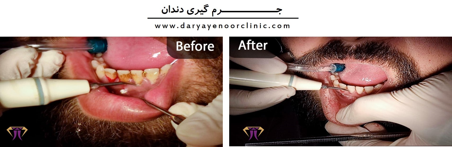 جرم-گیری-دندان-min.jpg