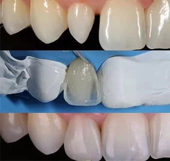 composite-veneers.jpg
