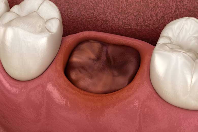 Dry-Socket.jpg Dry-Socket.jpg