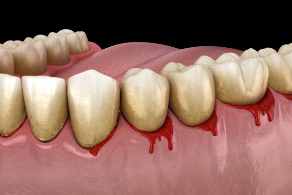 Gingivitis.jpg