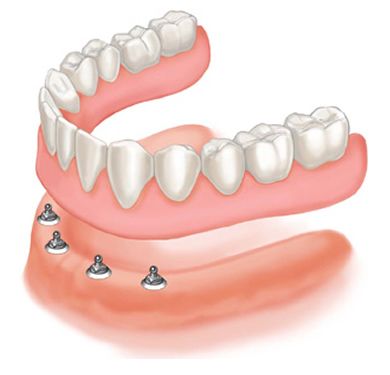 Immediate Dentures.jpg