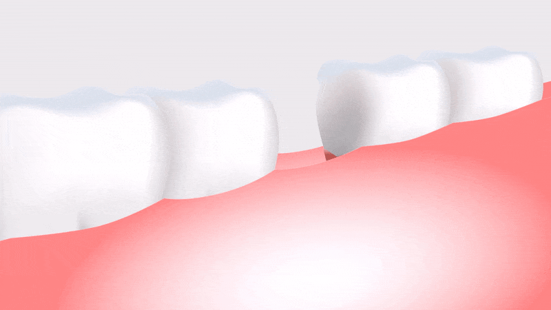 Implants-min.gif Implants-min.gif