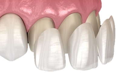 Porcelain Veneers.jpg Porcelain Veneers.jpg