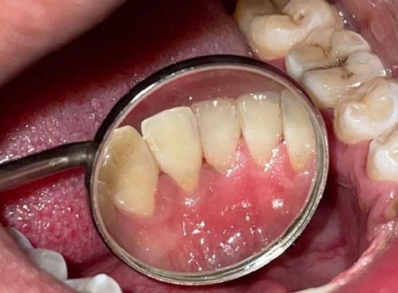 Scaling teeth.jpg Scaling teeth.jpg