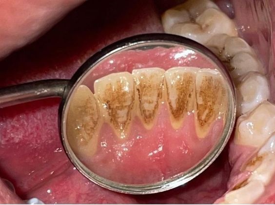Scaling teeth 1.jpg Scaling teeth 1.jpg