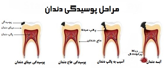 The stage of tooth decay.jpg