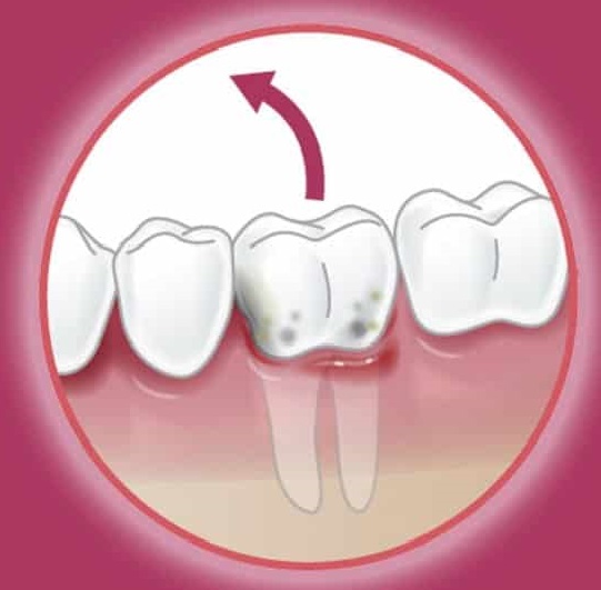 Tooth-extraction_.jpg
