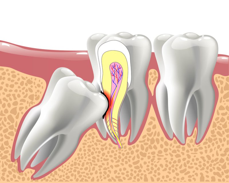 دندان عقل نهفته WISDOM-TEETH..jpg