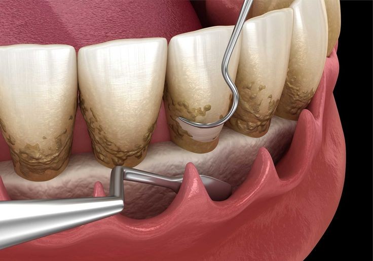 جراحی تخصصی لثه در کلینیک دندانپزشکی دریای نور