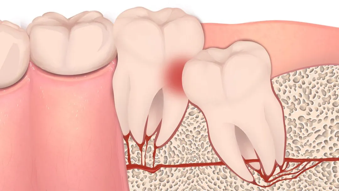 راهنمای جامع جراحی دندان عقل | روش‌های نوین و نکات مهم
