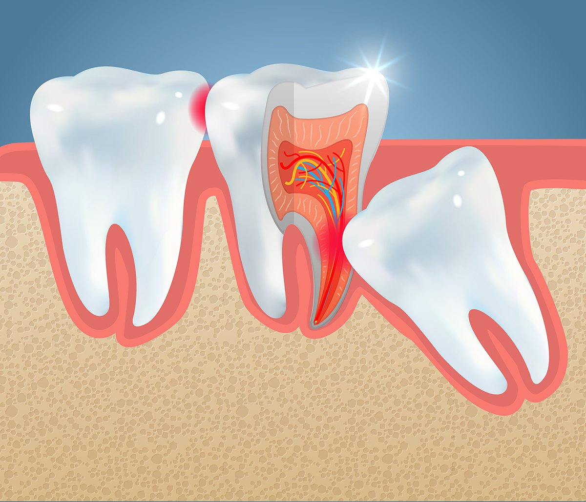 آبسه دندان عقل best-wisdom-teeth-treatment-provider-scarborough.jpg