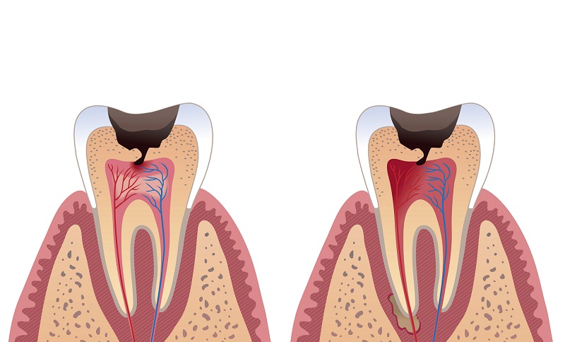 cavitiy illustration.jpg