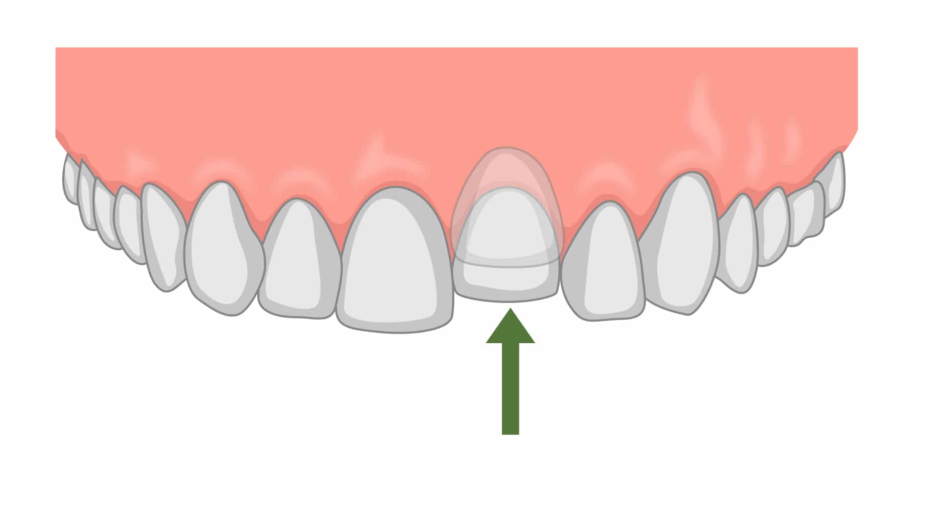 dental ankylosis.jpg dental ankylosis.jpg