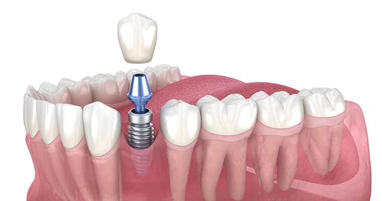 dental-implant-graphic.jpg dental-implant-graphic.jpg