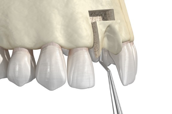 guided-tissue-bone-regeneration-2.jpg