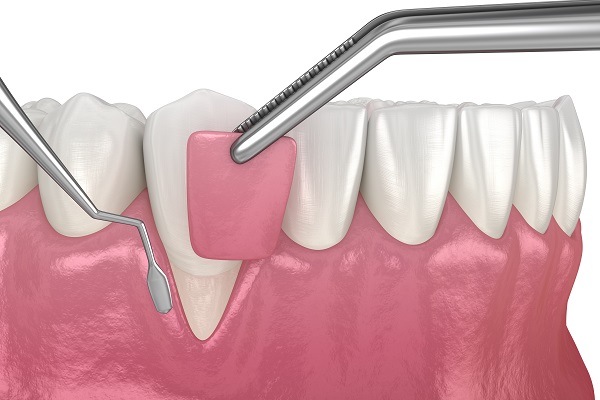 gum-graft-2108.jpg