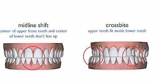 open bite - Copy (2).jpg