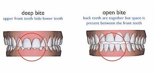 open bite - Copy (3).jpg