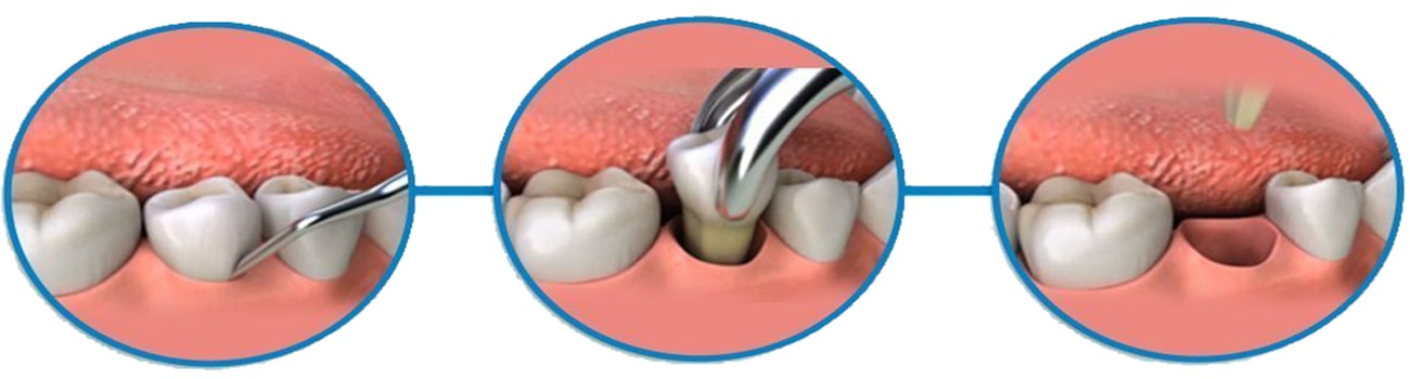pull-tooth-baner.jpg pull-tooth-baner.jpg