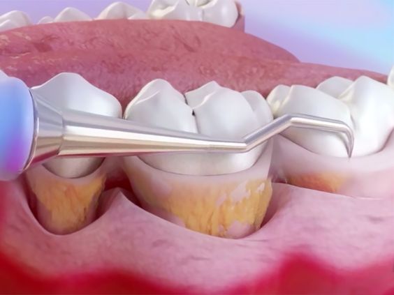 tooth enclaves.jpg