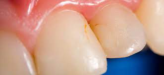 tooth necrosis.jpg tooth necrosis.jpg