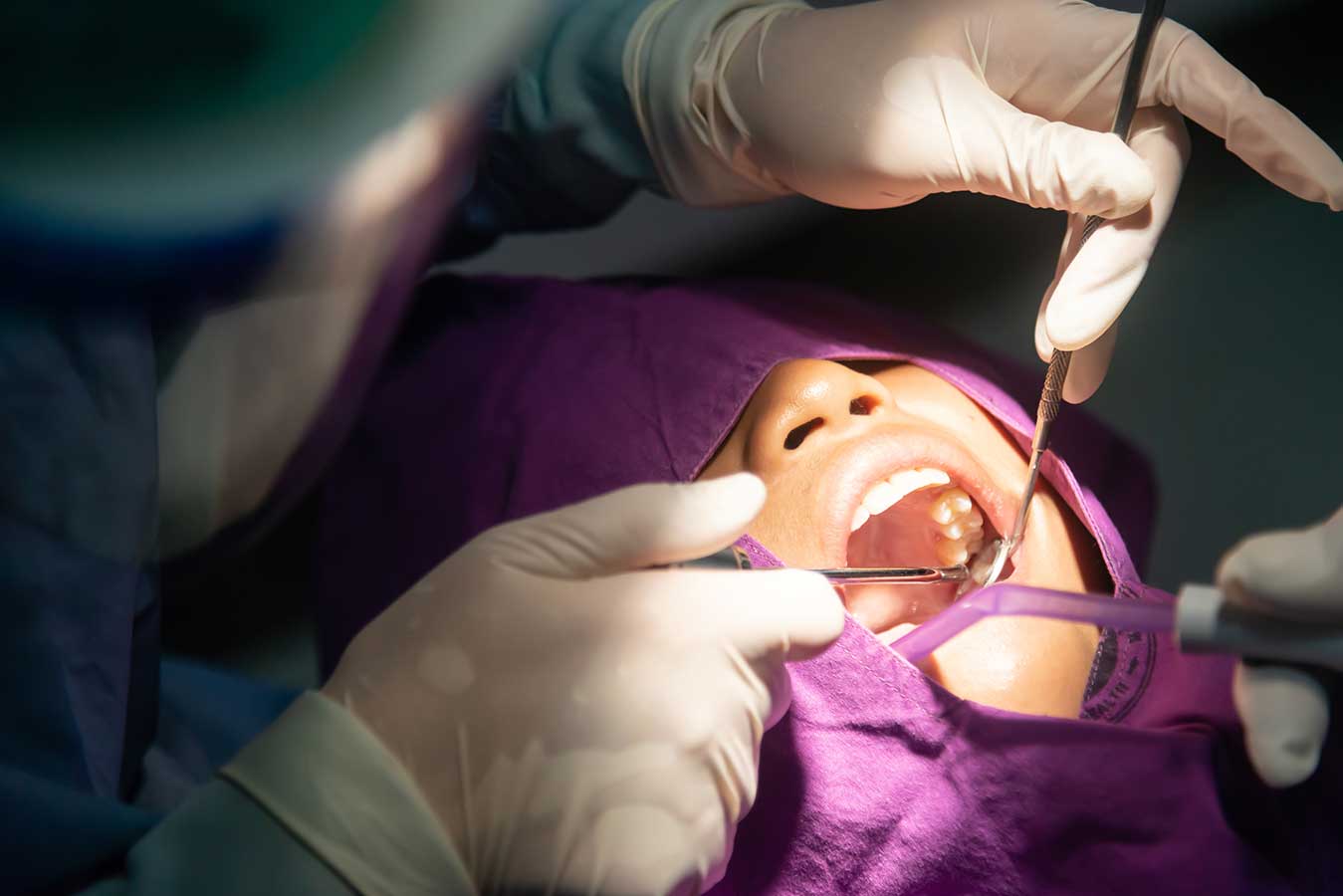 جراحی دندان عقل wisdom-tooth-removal-big-img.jpg